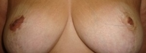 areola antes