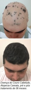 doença alopecia_paint