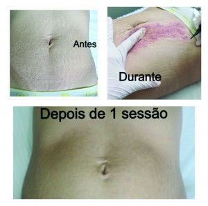 foto antes depois - semeia